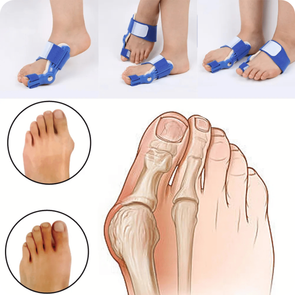 FlexiToe: Corrector de Juanetes - [PROMOCIÓN DISPONIBLE SOLO HOY]