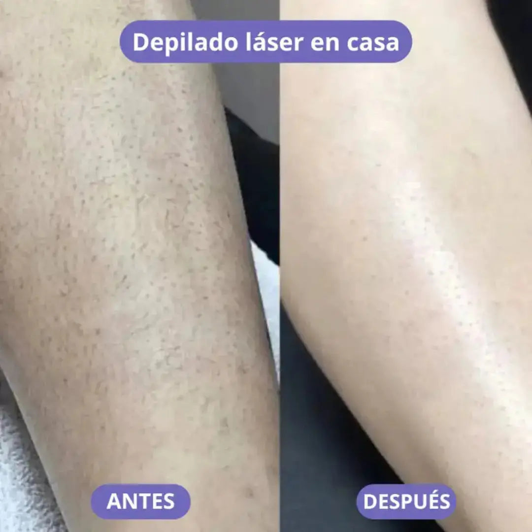LisseLáser - Dile Adiós a los Vellos Indeseados 🌸