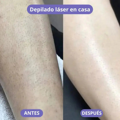 LisseLáser - Dile Adiós a los Vellos Indeseados 🌸